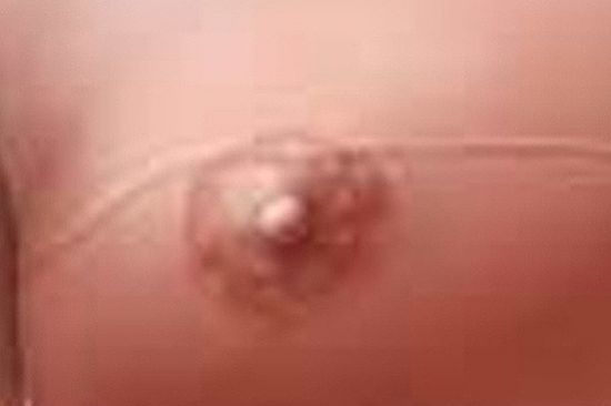 Areola 